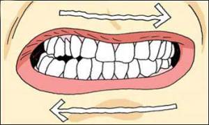 Bruxism or tooth grinding